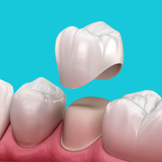 Dental Crowns at Bambi Dental Clinics