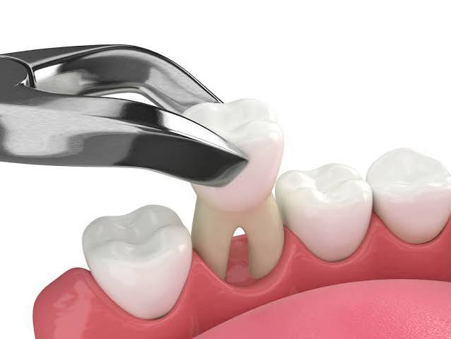 Tooth Extraction at Bambi Dental Clinics