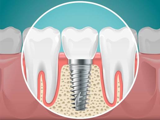 Dental Implants at Bambi Dental Clinics
