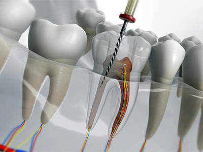 Root Canal Treatment at Bambi Dental Clinics