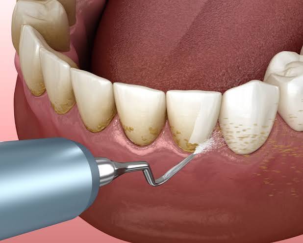 Scaling and Polishing/ Tooth Cleaning at Bambi Dental Clinics