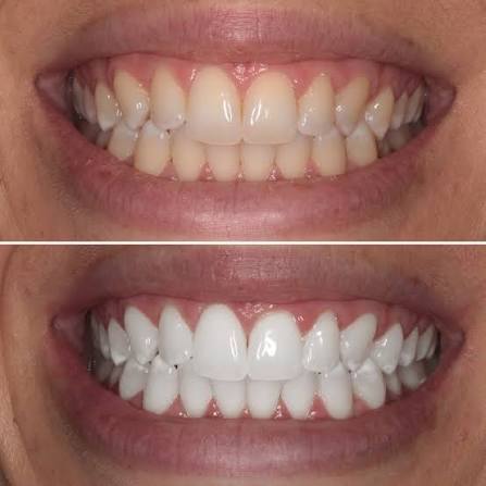 Teeth Whitening at Bambi Dental Clinics